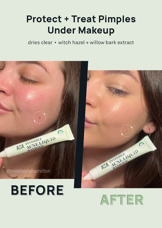 AOA Skin Invisible Acne Liquid Bandage